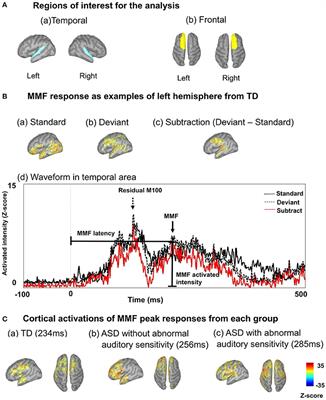 Delayed Mismatch Field Latencies in Autism Spectrum Disorder with Abnormal Auditory Sensitivity: A Magnetoencephalographic Study